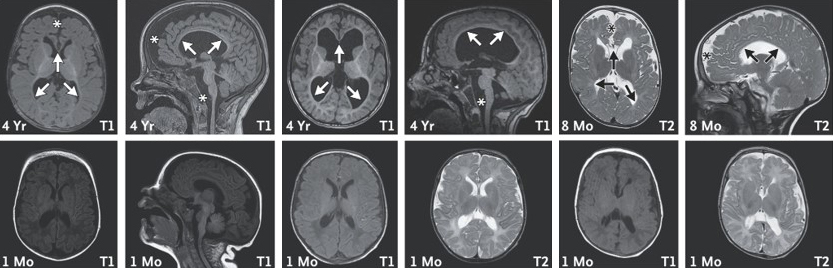 Magnetic resonance imaging (MRI) scans of the brain in three children with a missing copy of the Chaserr gene.